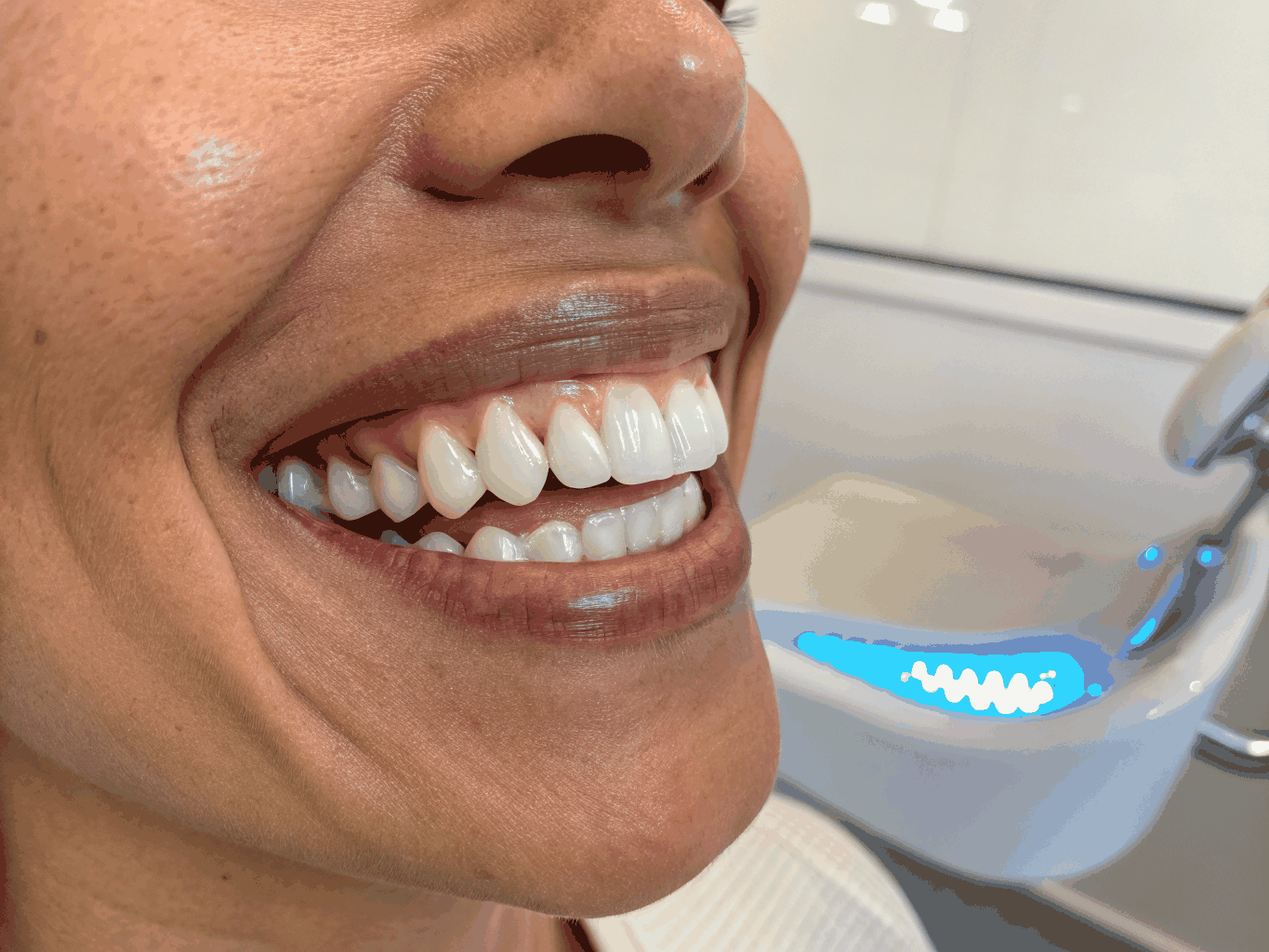 Composite Bonding Transformation after treatment