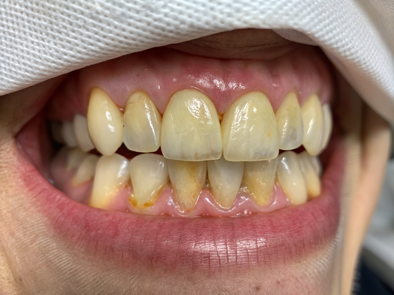 Porcelain Veneers Makeover before treatment