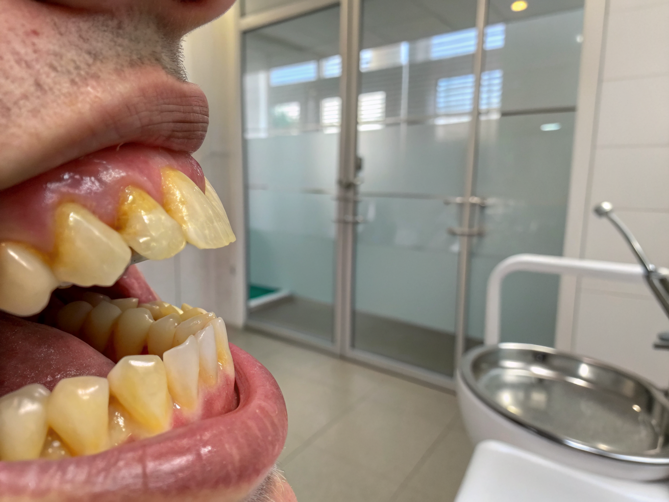 Deep Stain Laser Whitening before treatment